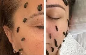 Yüz bölgesine sülük terapisi uygulaması
